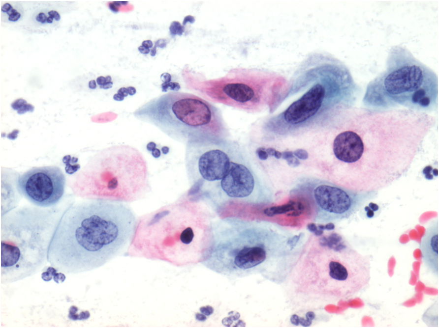 Dyskaryosis - Abnormal Smear Test & Treatment