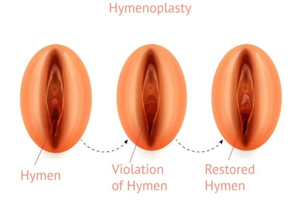 Hymenoplasty