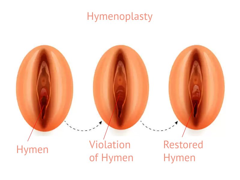 Hymenoplasty