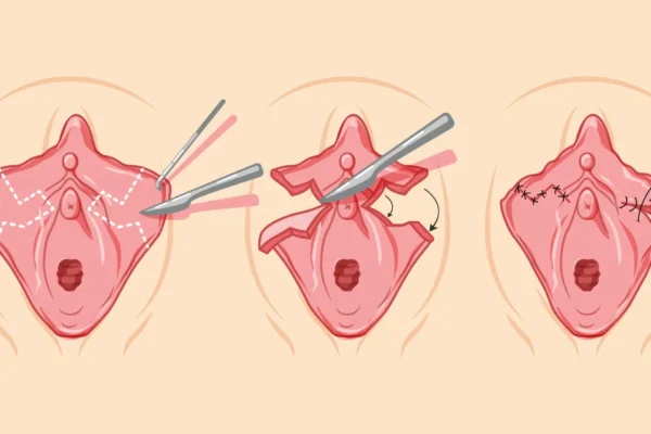 Labiaplasty
