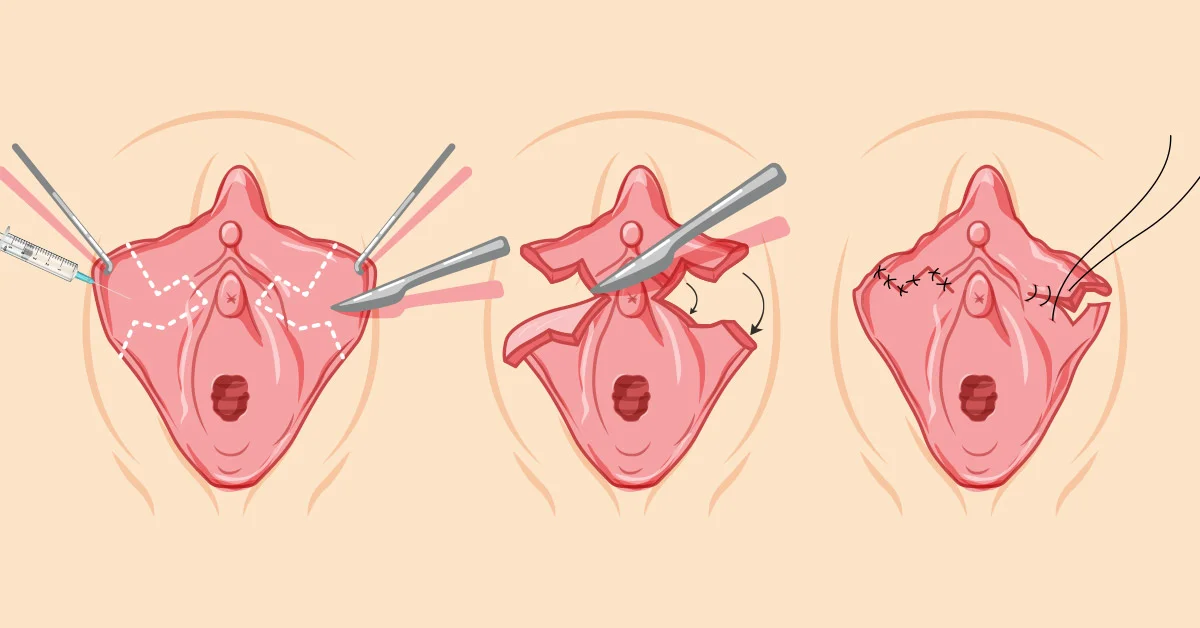 Labiaplasty