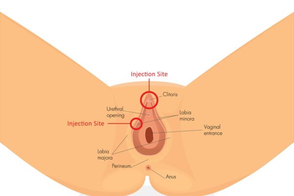 O-Shot — Vaginal PRP