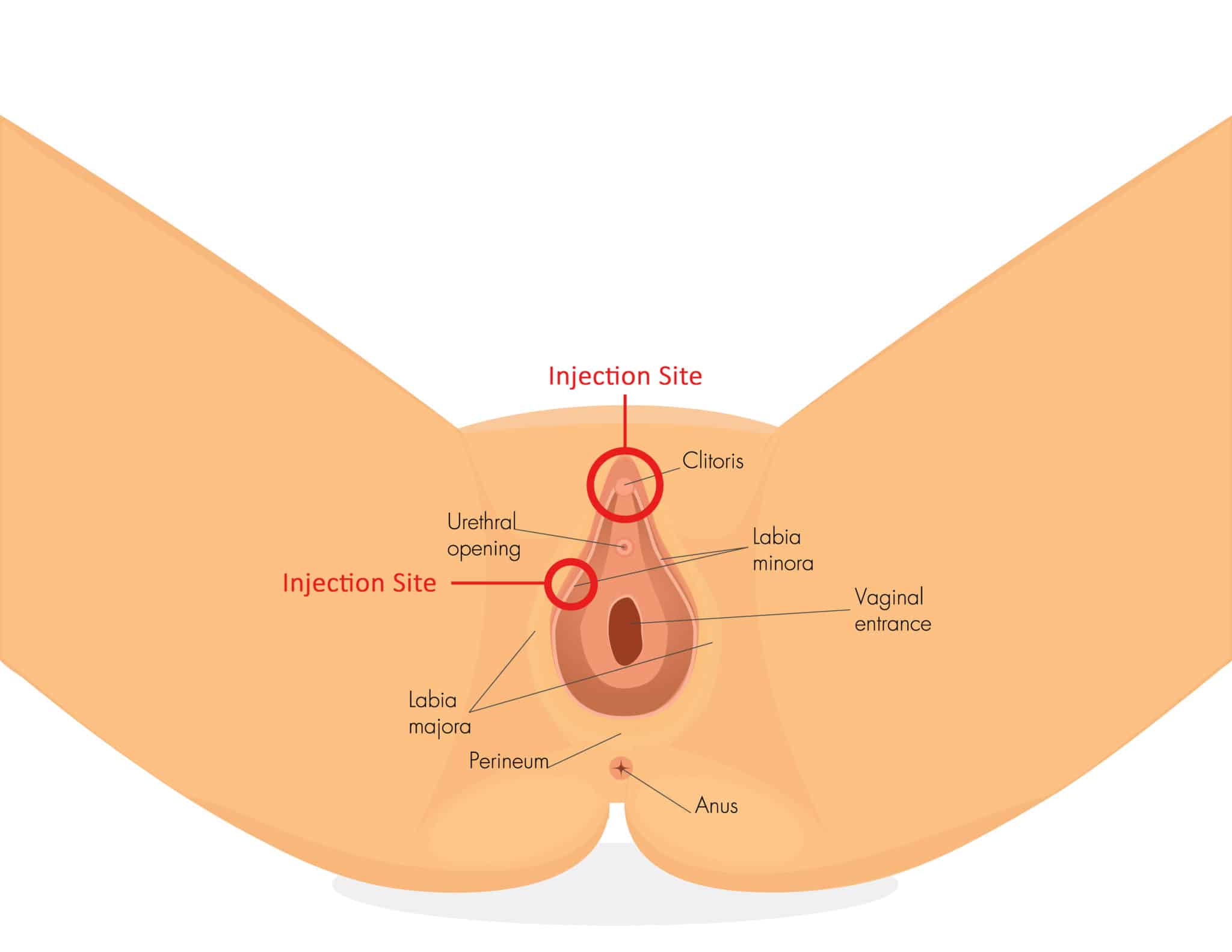 O-Shot — Vaginal PRP