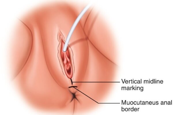 Perineoplasty