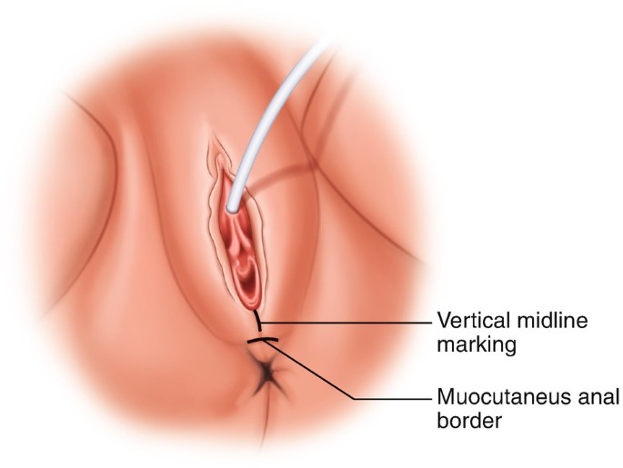Perineoplasty