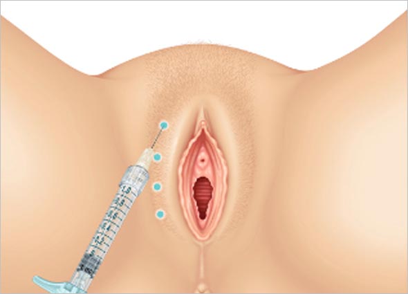 Vulvar Hyaluronic Acid Filler